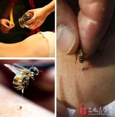蜜蜂治疗风原理（蜜蜂疗法有副作用吗）-第1张图片-新疆蜂业信息网